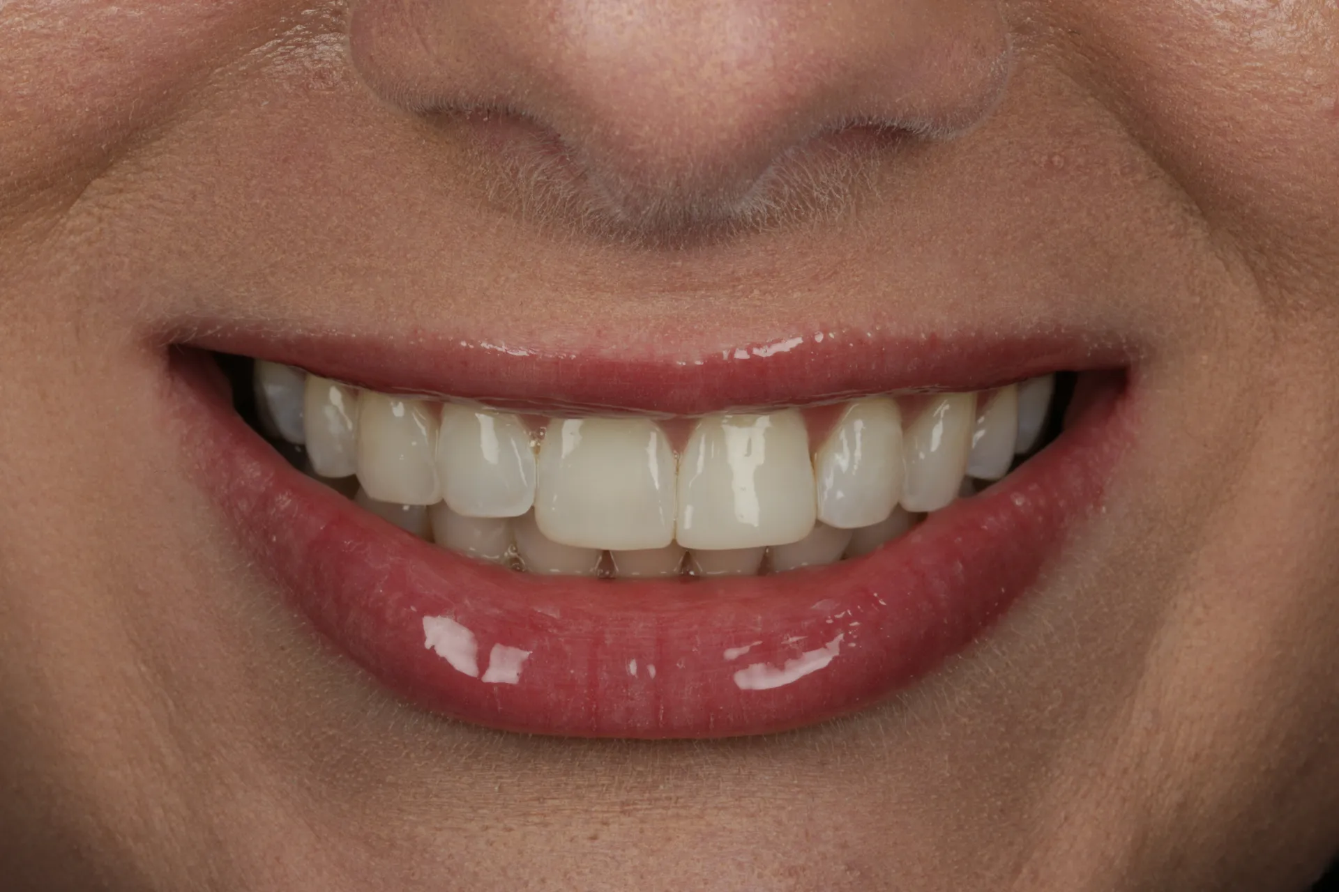 Invisalign Buxton | Platinum Provider | Clear Aligners Derbyshire